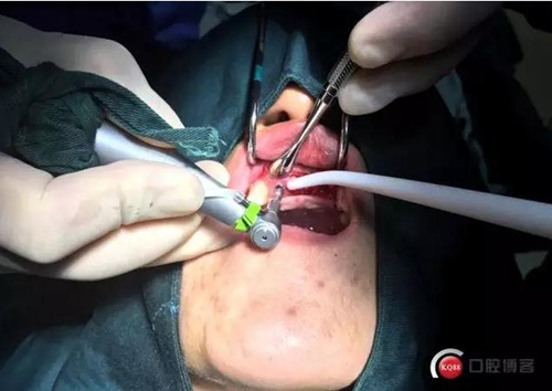 一例前牙重度牙周病8個月的種植漫長修復(fù) 一例前牙重度牙周病8個月的種植漫長修復(fù)