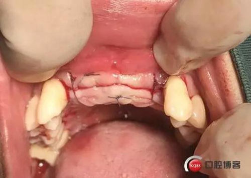 一例前牙重度牙周病8個月的種植漫長修復(fù) 一例前牙重度牙周病8個月的種植漫長修復(fù)