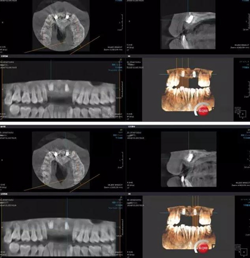 一例前牙重度牙周病8個月的種植漫長修復(fù) 一例前牙重度牙周病8個月的種植漫長修復(fù)