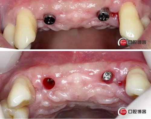 一例前牙重度牙周病8個月的種植漫長修復(fù) 一例前牙重度牙周病8個月的種植漫長修復(fù)