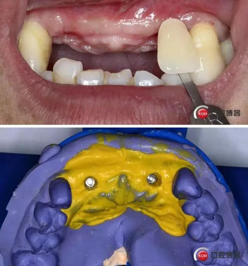 一例前牙重度牙周病8個月的種植漫長修復(fù) 一例前牙重度牙周病8個月的種植漫長修復(fù)