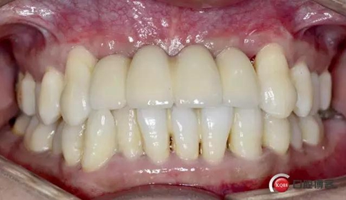 一例前牙重度牙周病8個月的種植漫長修復(fù) 一例前牙重度牙周病8個月的種植漫長修復(fù)