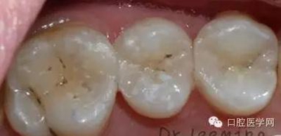 牙齒修復(fù) 牙齒修復(fù)