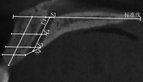 正常人群上頜前牙區(qū)鼻腭管相關(guān)解剖結(jié)構(gòu)的錐形束CT研究 正常人群上頜前牙區(qū)鼻腭管相關(guān)解剖結(jié)構(gòu)的錐形束CT研究
