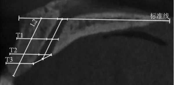 正常人群上頜前牙區(qū)鼻腭管相關(guān)解剖結(jié)構(gòu)的錐形束CT研究 正常人群上頜前牙區(qū)鼻腭管相關(guān)解剖結(jié)構(gòu)的錐形束CT研究