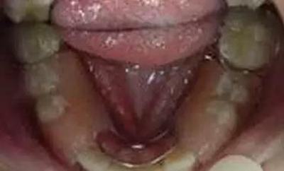 間隙保持器的應(yīng)用 間隙保持器的應(yīng)用