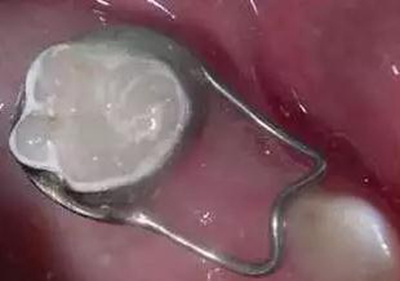 間隙保持器的應(yīng)用 間隙保持器的應(yīng)用