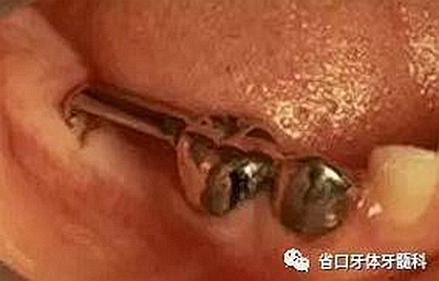 【牙醫(yī)學(xué)堂】間隙保持器的介紹 【牙醫(yī)學(xué)堂】間隙保持器的介紹