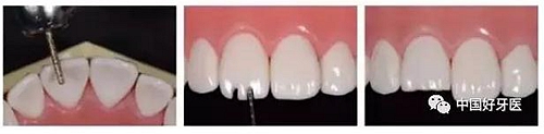 前牙全瓷冠牙體預(yù)備步驟 前牙全瓷冠牙體預(yù)備步驟