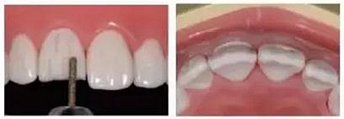 前牙全瓷冠牙體預(yù)備步驟 前牙全瓷冠牙體預(yù)備步驟