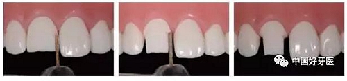 前牙全瓷冠牙體預(yù)備步驟 前牙全瓷冠牙體預(yù)備步驟