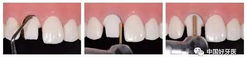 前牙全瓷冠牙體預(yù)備步驟 前牙全瓷冠牙體預(yù)備步驟