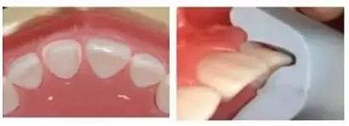 前牙全瓷冠牙體預(yù)備步驟 前牙全瓷冠牙體預(yù)備步驟