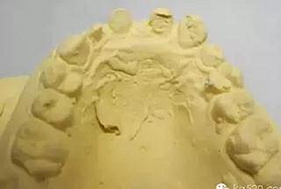 義齒加工技師想對醫(yī)生說的話 義齒加工技師想對醫(yī)生說的話