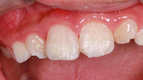 劉勇:斷牙再粘結(jié)兩例病例 劉勇:斷牙再粘結(jié)兩例病例