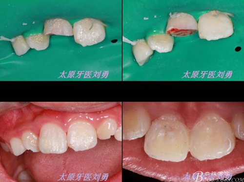 劉勇:斷牙再粘結(jié)兩例病例 劉勇:斷牙再粘結(jié)兩例病例