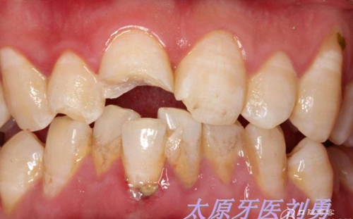 劉勇:斷牙再粘結(jié)兩例病例 劉勇:斷牙再粘結(jié)兩例病例