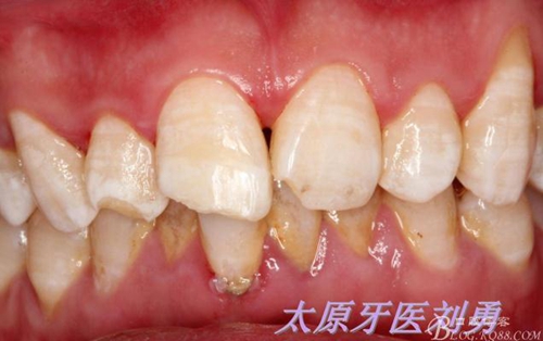 劉勇:斷牙再粘結(jié)兩例病例 劉勇:斷牙再粘結(jié)兩例病例