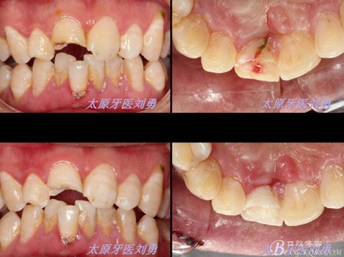 劉勇:斷牙再粘結(jié)兩例病例 劉勇:斷牙再粘結(jié)兩例病例