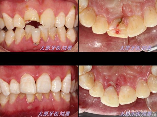 劉勇:斷牙再粘結(jié)兩例病例 劉勇:斷牙再粘結(jié)兩例病例
