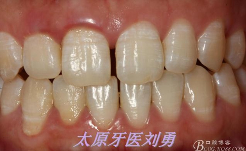 劉勇:斷牙再粘結(jié)兩例病例 劉勇:斷牙再粘結(jié)兩例病例