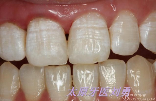 劉勇:斷牙再粘結(jié)兩例病例 劉勇:斷牙再粘結(jié)兩例病例