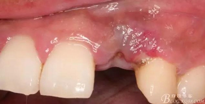 一例上前牙種植失敗病例的補救 一例上前牙種植失敗病例的補救