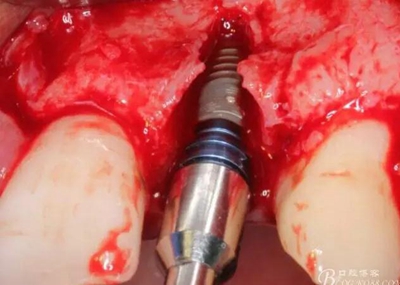 一例上前牙種植失敗病例的補救 一例上前牙種植失敗病例的補救