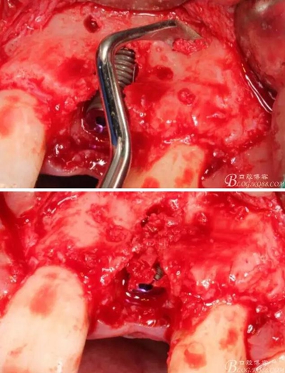 一例上前牙種植失敗病例的補救 一例上前牙種植失敗病例的補救