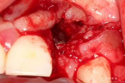 一例上前牙種植失敗病例的補救 一例上前牙種植失敗病例的補救