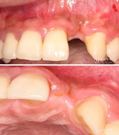 一例上前牙種植失敗病例的補救 一例上前牙種植失敗病例的補救