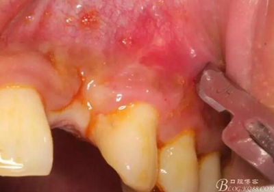 一例上前牙種植失敗病例的補救 一例上前牙種植失敗病例的補救