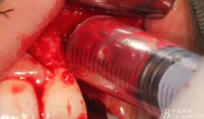 一例上前牙種植失敗病例的補救 一例上前牙種植失敗病例的補救