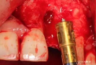 一例上前牙種植失敗病例的補救 一例上前牙種植失敗病例的補救