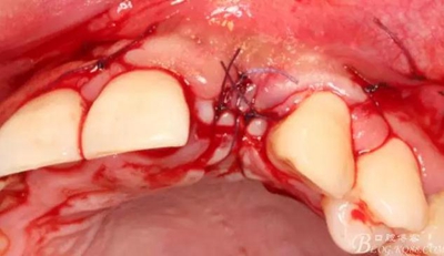 一例上前牙種植失敗病例的補救 一例上前牙種植失敗病例的補救