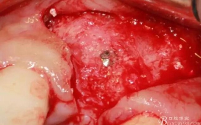 一例上前牙種植失敗病例的補救 一例上前牙種植失敗病例的補救