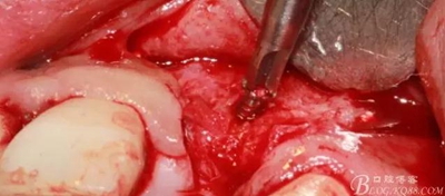 一例上前牙種植失敗病例的補救 一例上前牙種植失敗病例的補救