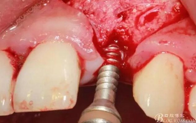 一例上前牙種植失敗病例的補救 一例上前牙種植失敗病例的補救