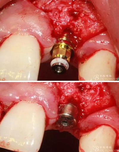 一例上前牙種植失敗病例的補救 一例上前牙種植失敗病例的補救