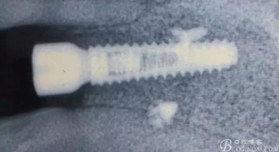 一例上前牙種植失敗病例的補救 一例上前牙種植失敗病例的補救