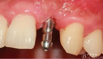 一例上前牙種植失敗病例的補救 一例上前牙種植失敗病例的補救