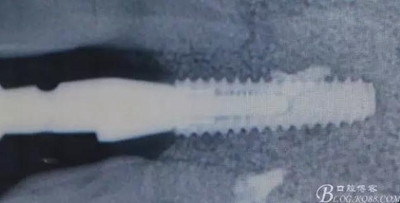 一例上前牙種植失敗病例的補救 一例上前牙種植失敗病例的補救