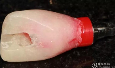 一例上前牙種植失敗病例的補救 一例上前牙種植失敗病例的補救