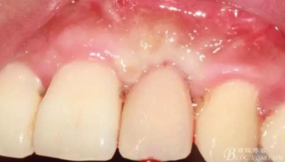 一例上前牙種植失敗病例的補救 一例上前牙種植失敗病例的補救