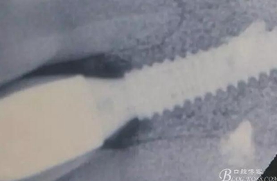 一例上前牙種植失敗病例的補救 一例上前牙種植失敗病例的補救