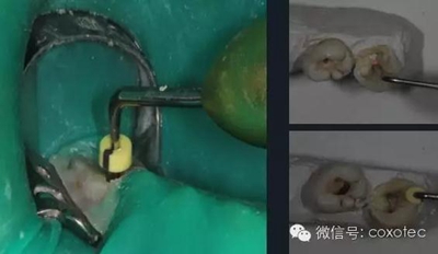 【現(xiàn)代根管治療】之熱牙膠充填技術(shù) 【現(xiàn)代根管治療】之熱牙膠充填技術(shù)