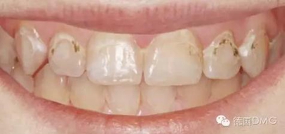 Icon 愛康滲透樹脂使用說(shuō)明書 Icon 愛康滲透樹脂使用說(shuō)明書