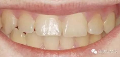 Icon 愛康滲透樹脂使用說(shuō)明書 Icon 愛康滲透樹脂使用說(shuō)明書