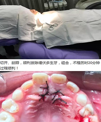 多生牙的拔除總原則：早發(fā)現(xiàn)，早處理！