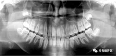 種植釘多維運(yùn)用矯正高角反頜及開頜—對(duì)羅晨醫(yī)生專訪及病例展示(上) 種植釘多維運(yùn)用矯正高角反頜及開頜—對(duì)羅晨醫(yī)生專訪及病例展示(上)